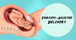 Forceps-Assisted Delivery