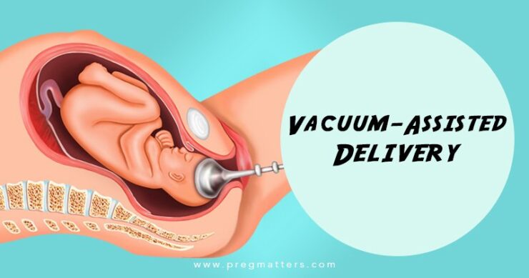 Vacuum-Assisted Delivery