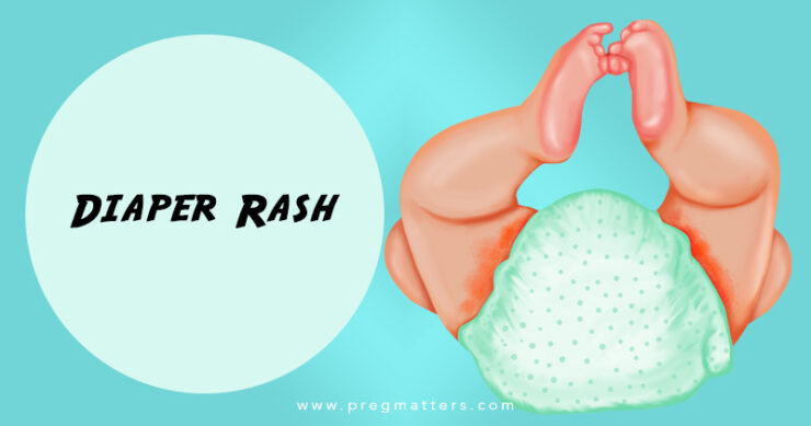 Diaper Rash